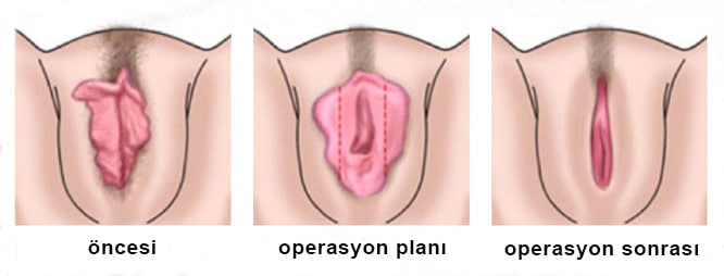 Genital Estetik Öncesi - Sonrası